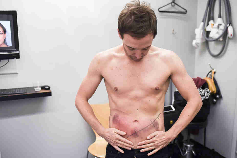 man getting fat frozen off