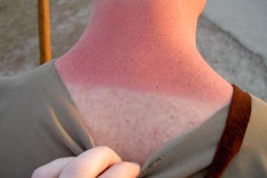 Sunburn