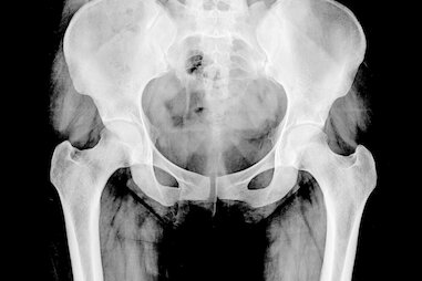 X-Ray of a person’s pelvis