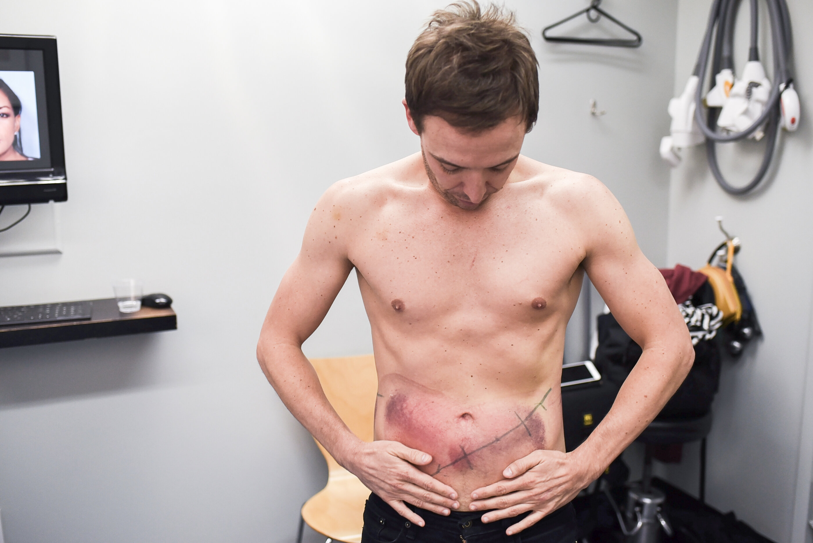 man getting fat frozen off