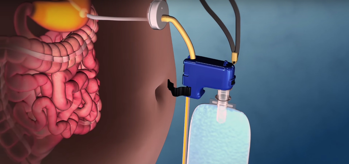 AspireAssist Easy Weight Loss Device Thrillist