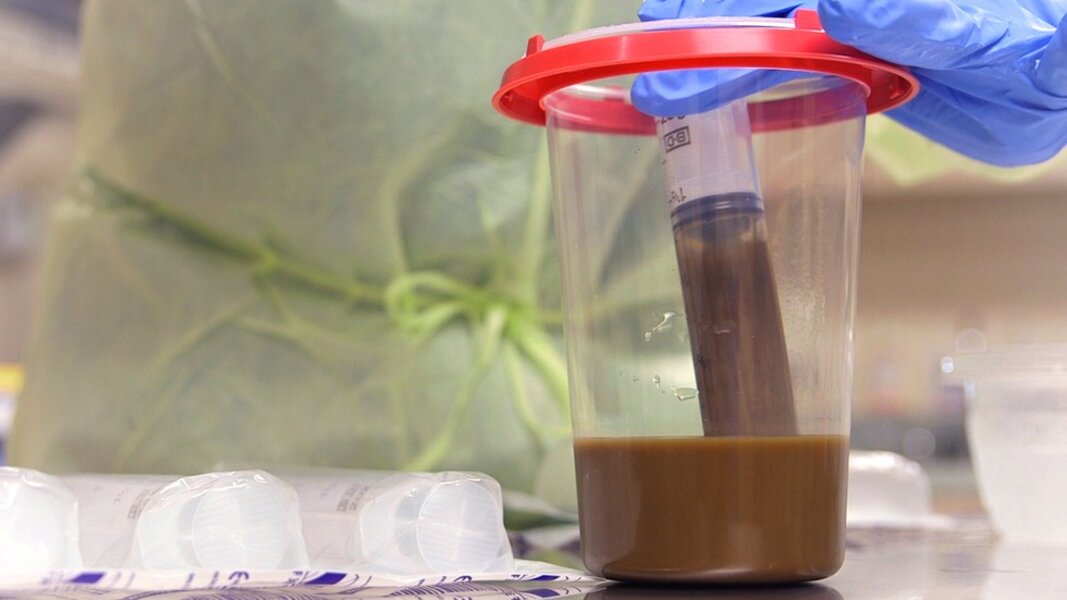 The Future Of Poop Transplants Seeker