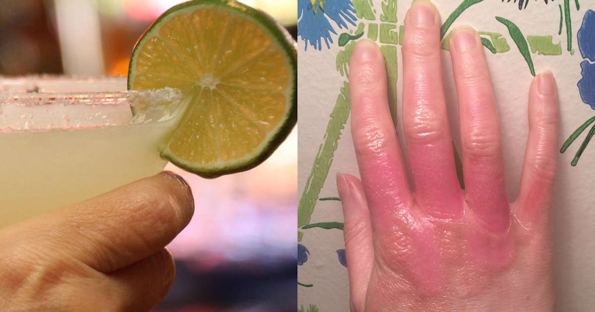 Phytophotodermatitis Treatment How to Treat Citrus Burn Thrillist