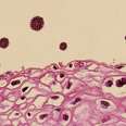 This Is How HPV Causes Cancer