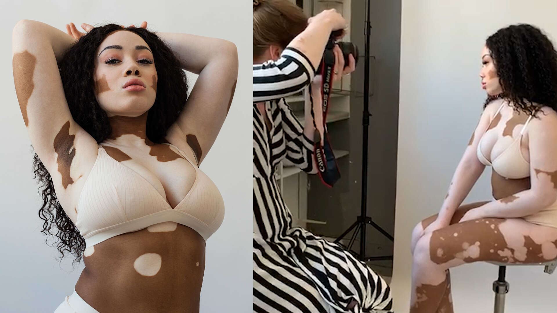 'Shades of Pale' Photo Series Highlights Women Living With Vitiligo