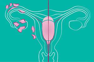 What Is Endometriosis? 