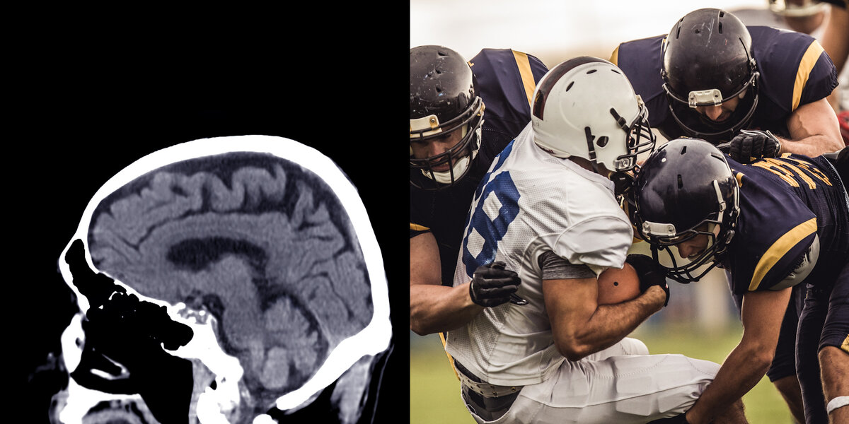 High Prevalence of Evidence of CTE in Brains of Deceased Football Players -  Neuroscience News