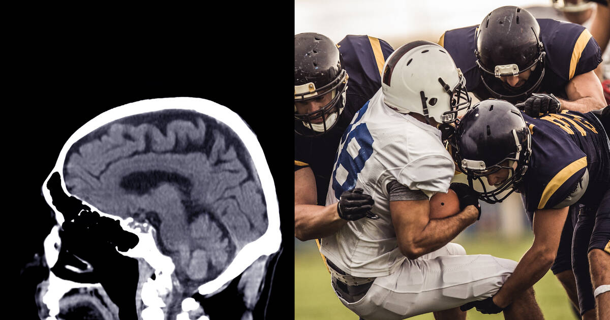 Study: 91.7% of Former NFL Players Studied Had CTE a Degenerative Brain  Disease - NowThis