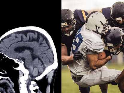 Why Are So Many Football Players Receiving Inappropriate CTE diagnosis” -  Harvard Study : r/nfl